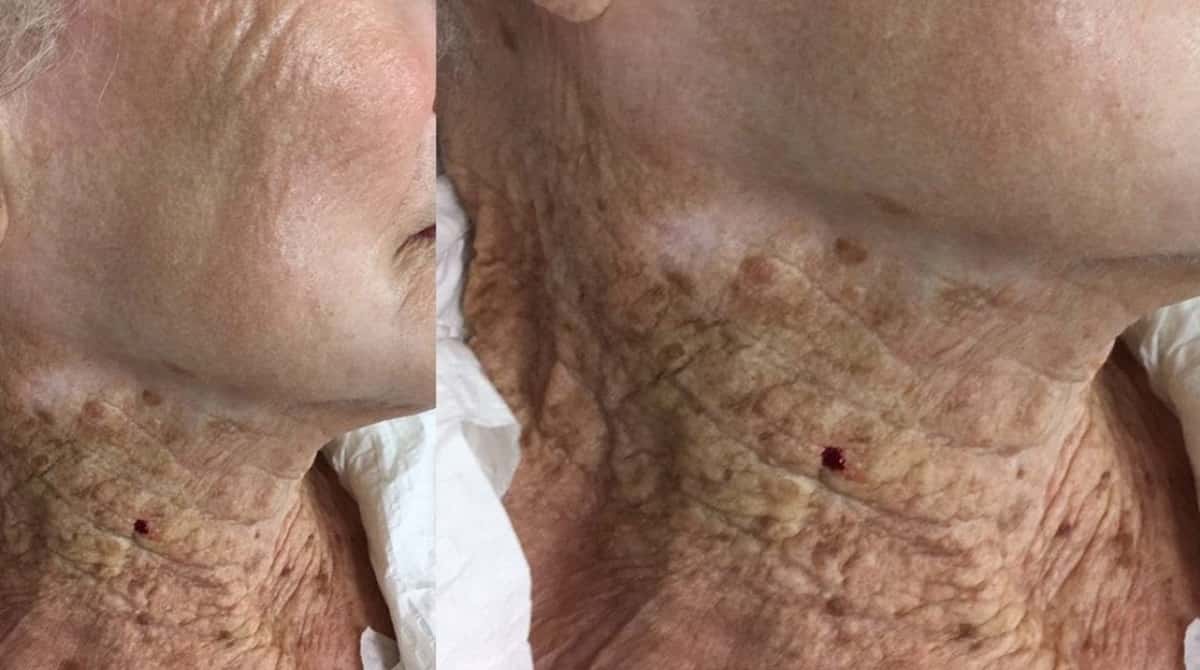 Crema solare va messa anche sul collo, altrimenti ecco cosa succede FOTO