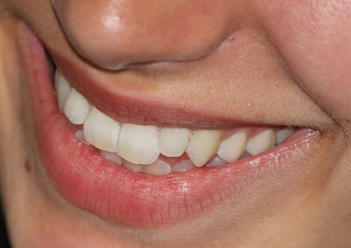 Parodontite, chi ne soffre ha più possibilità di sviluppare il diabete