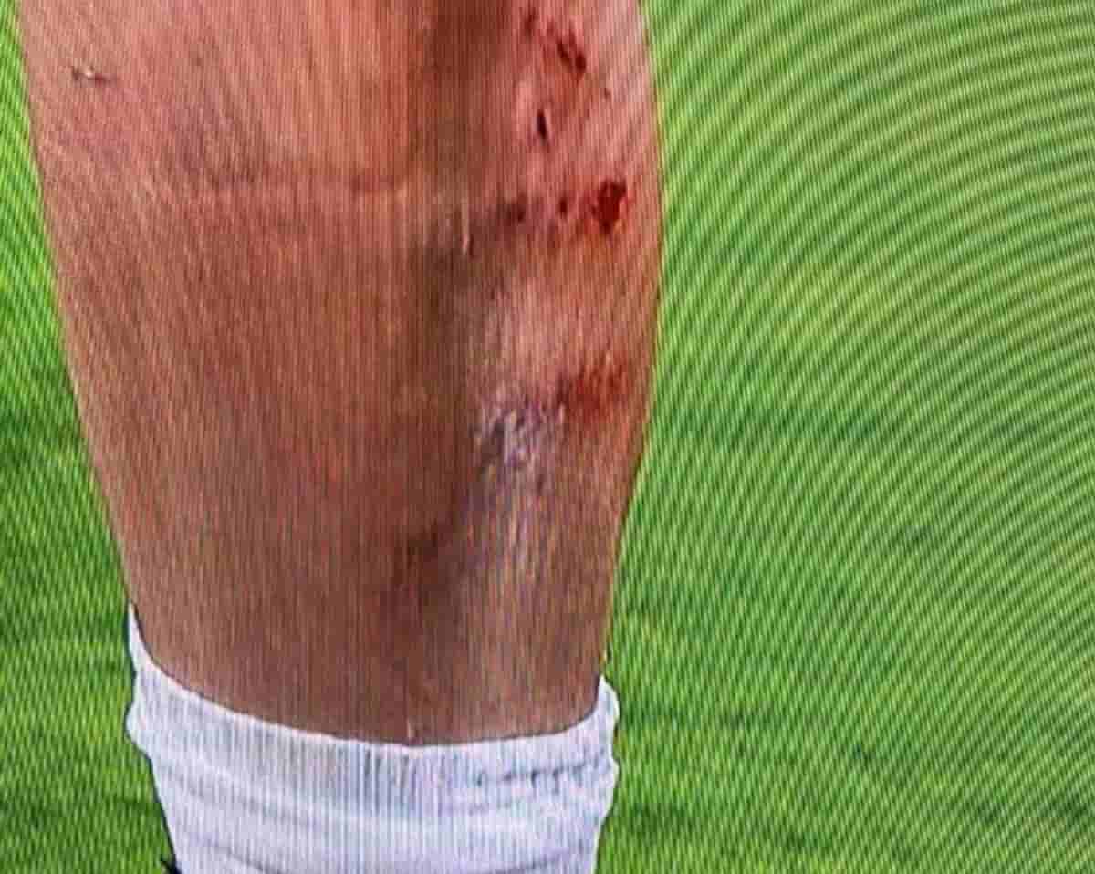 Rabiot e i segni dei tacchetti, foto