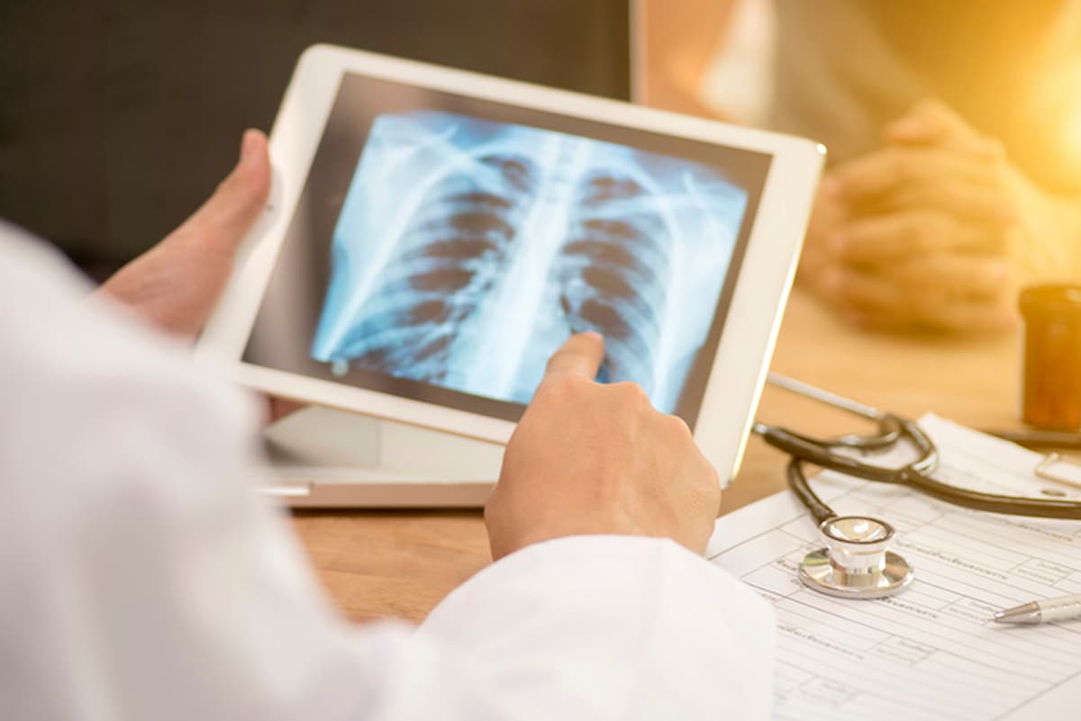 La tubercolosi, antica malattia infettiva mortale sta superando il Covid, come più letale al mondo