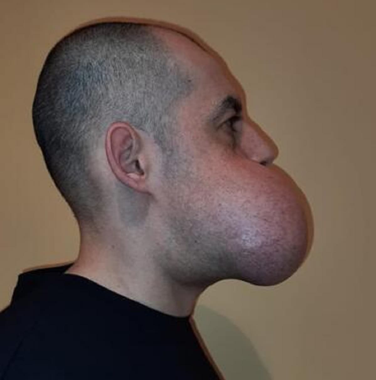 Mandibola ricostruita col perone, foto Ansa