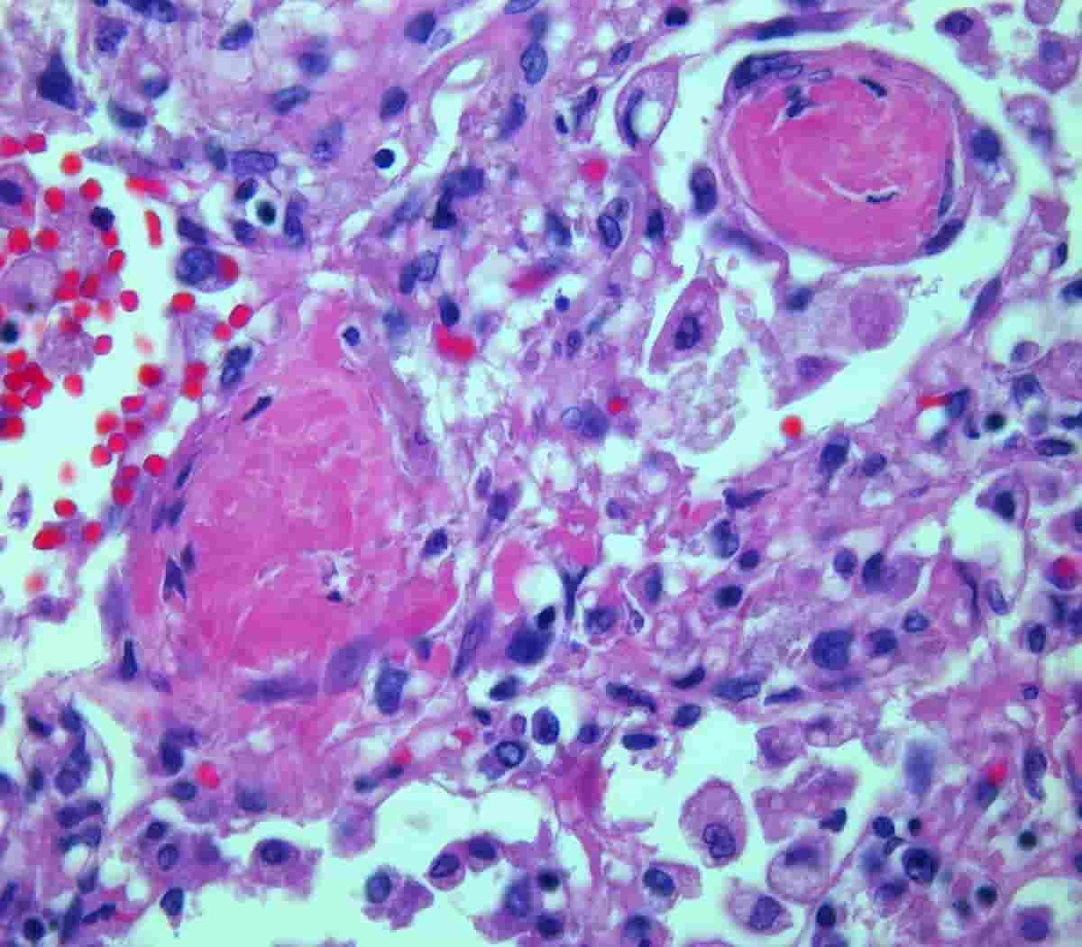 covid-19 danni polmoni