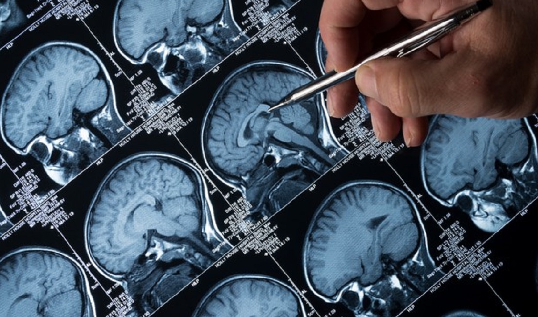 legame tra alzheimer e colesterolo alto